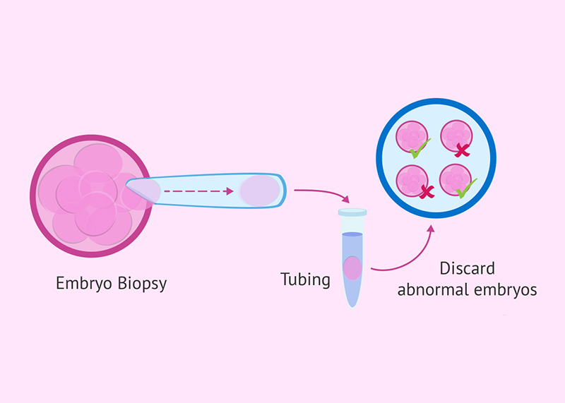 PGD ( Preimplanttation Genetic Diagnosis)